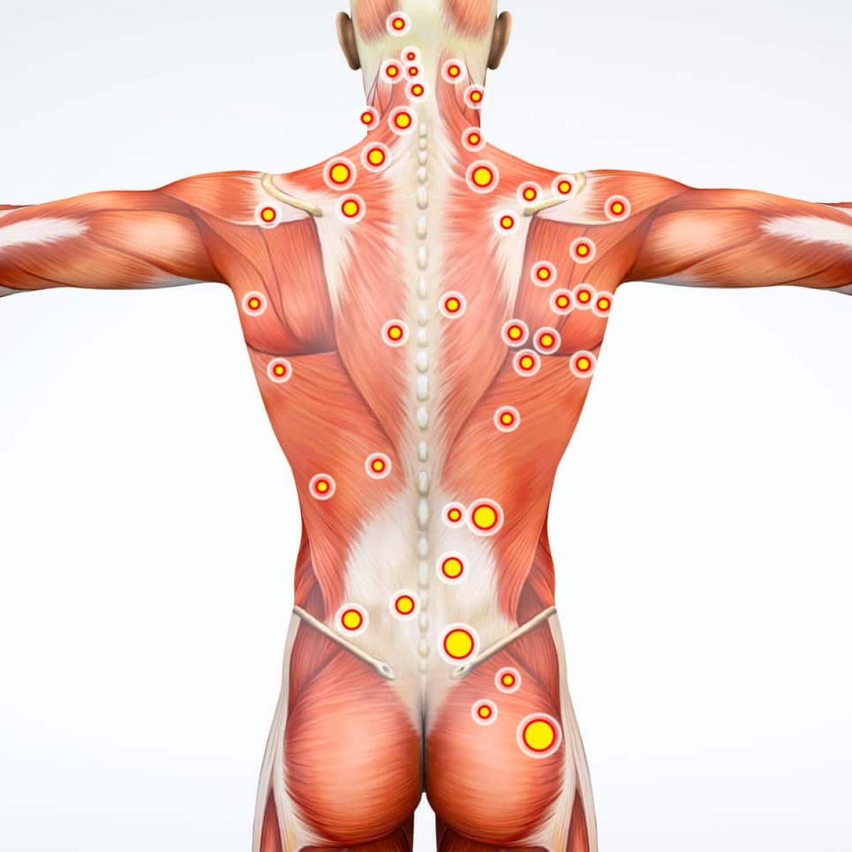 Waarom dry needling 