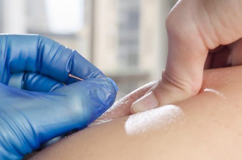 Dry needling opleiding